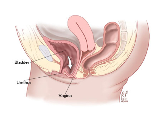 Prevalence And Degree Of Bother Of Pelvic Floor Disorder Symptoms